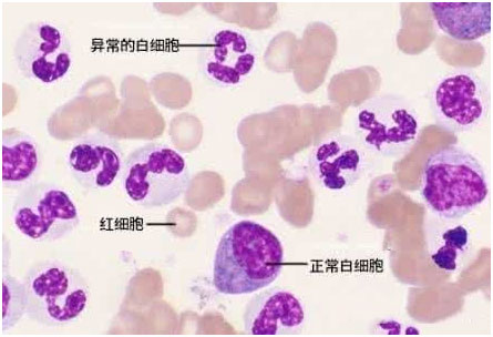 白血病，慢性粒細(xì)胞性白血病