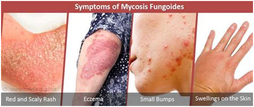 蕈樣真菌病(mycosis fugoides, MF),蕈樣肉芽腫