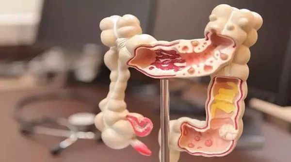 1634003694852418.jpg 腸癌1.jpg