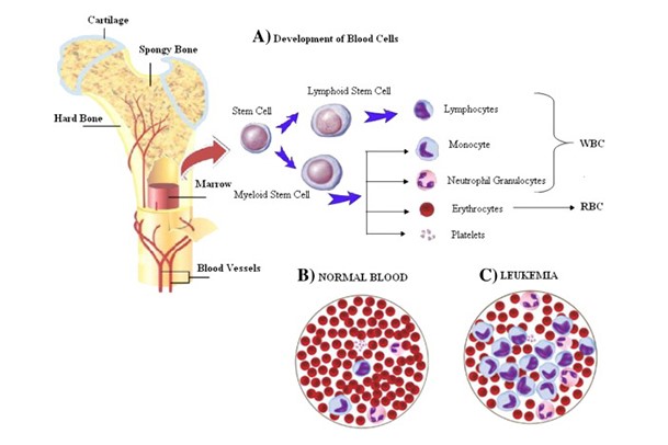 leukemia-cancer-treatment-in-india.jpg