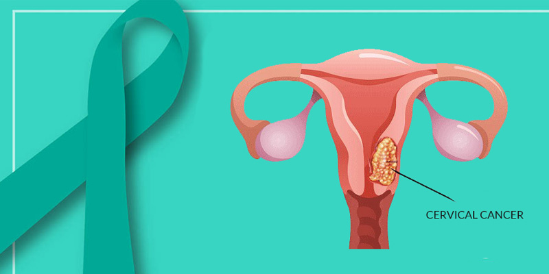 宮頸癌bi.jpg