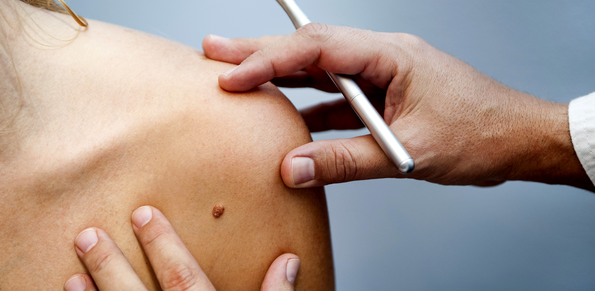 黑色素瘤 (16).jpg