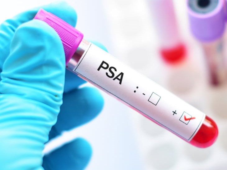 前列腺癌psa (2).jpg